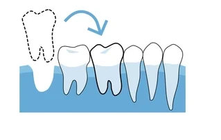 tooth transplant