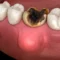 Causes of Tooth Abscess
