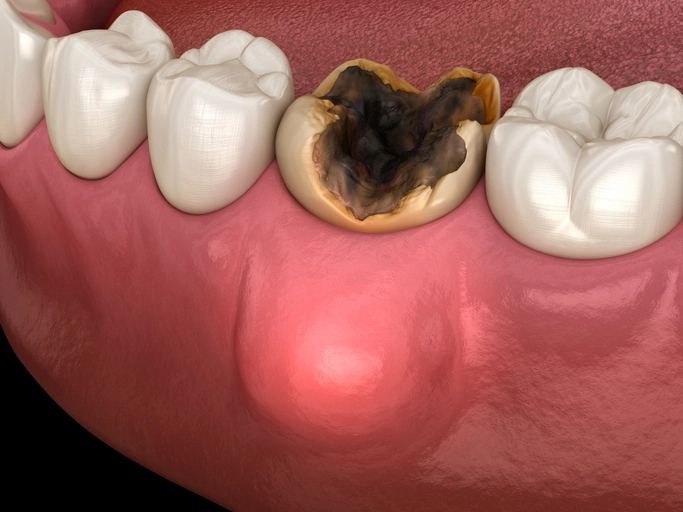 Causes of Tooth Abscess