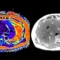 PET scan