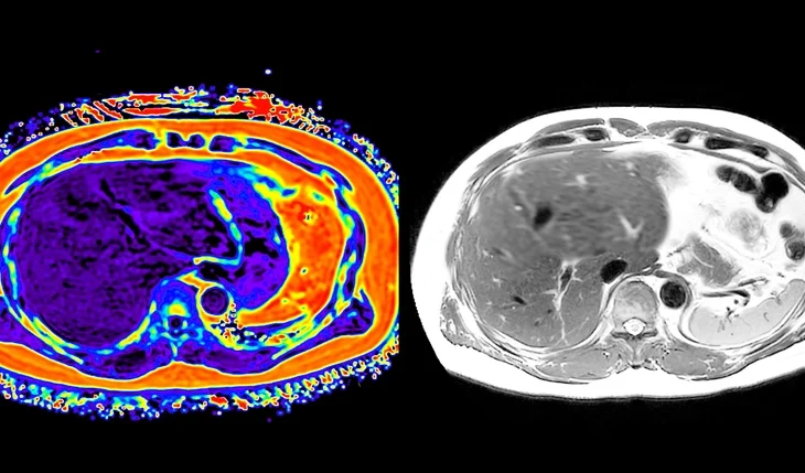 PET Scan A Comprehensive Guide PET Scan A Comprehensive Guide