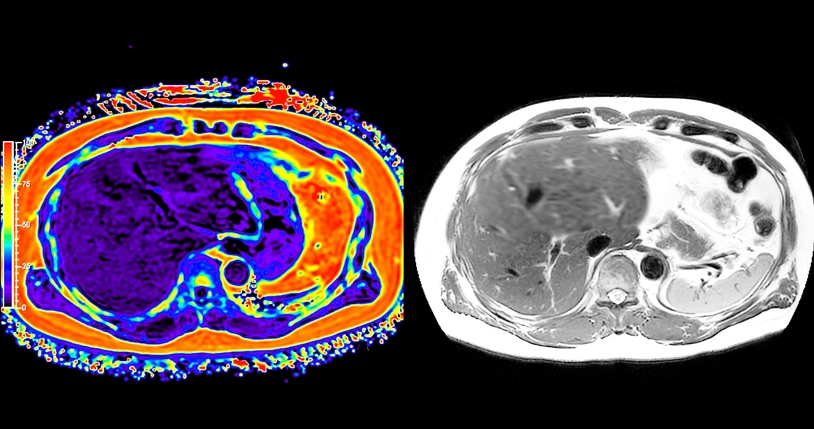 PET Scan: A Comprehensive Guide