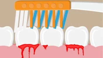 causes of bleeding gums