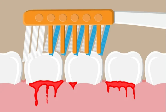 causes of bleeding gums