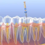 complex root canal anatomy