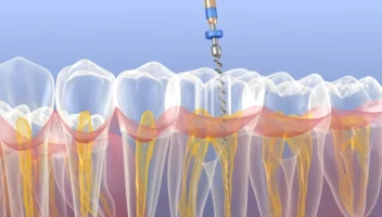 complex root canal anatomy