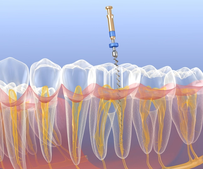 complex root canal anatomy