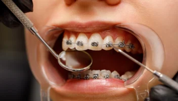 orthodontic wires