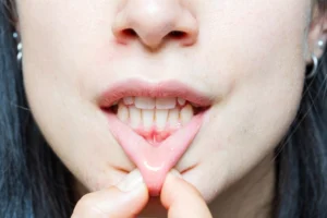 treatment receding gums