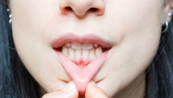 treatment receding gums