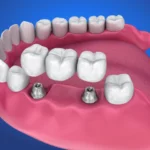 types of dental bridges