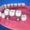 types of dental bridges