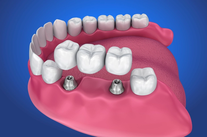 types of dental bridges