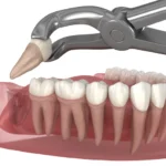 wisdom tooth extraction