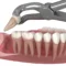 wisdom tooth extraction