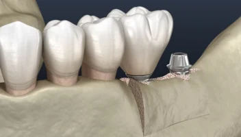 alveolar ridge augmentation