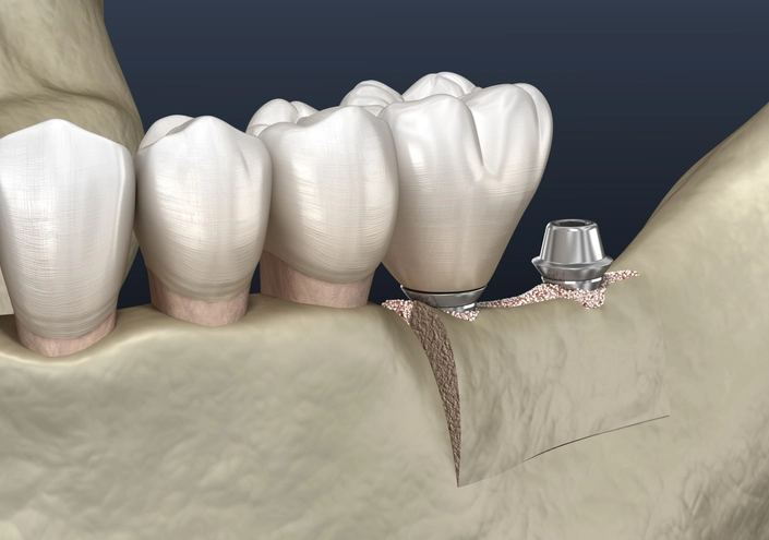 alveolar ridge augmentation