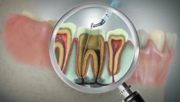cleaning and shaping of root canals