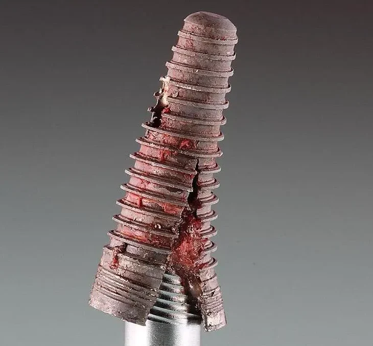 dental implant fractures