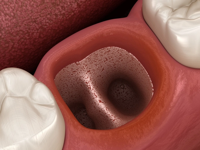socket preservation