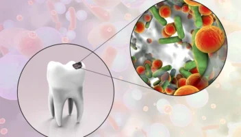 Bacterial Plaque and Dental Decay