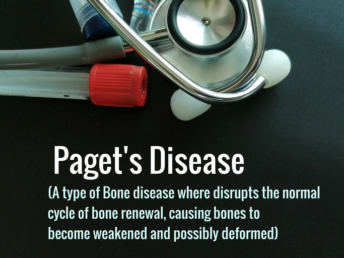 Paget’s disease