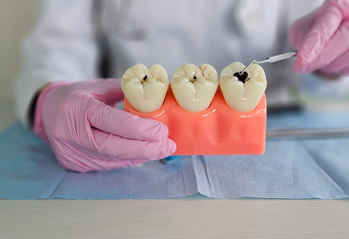 caries diagnosis