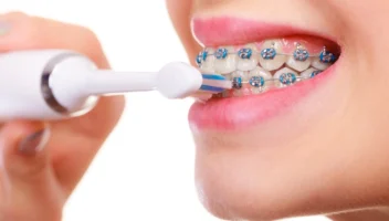 care for dental braces