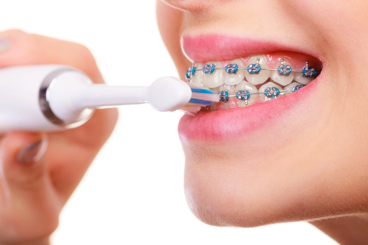 care for dental braces