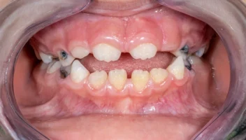 Abnormalities of Tooth Eruption and Exfoliation