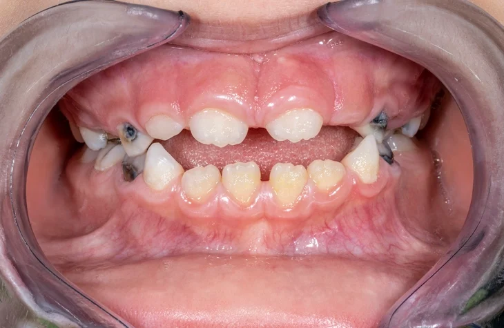 Abnormalities of Tooth Eruption and Exfoliation