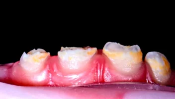 Abnormalities of tooth structure
