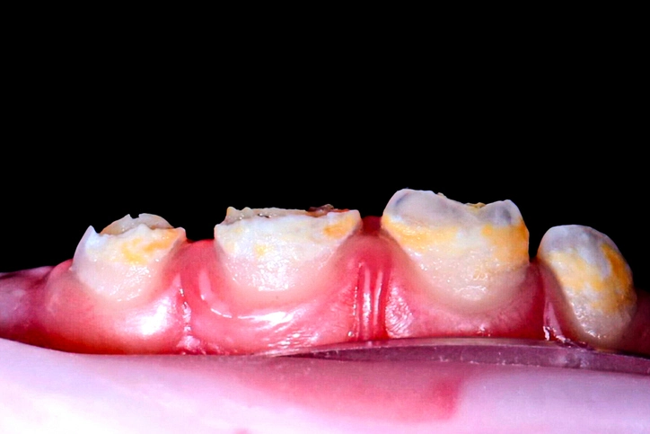 Abnormalities of tooth structure