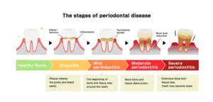 Classification of Periodontal Diseases