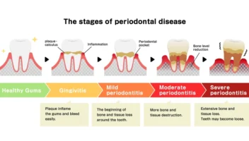 Classification of Periodontal Diseases