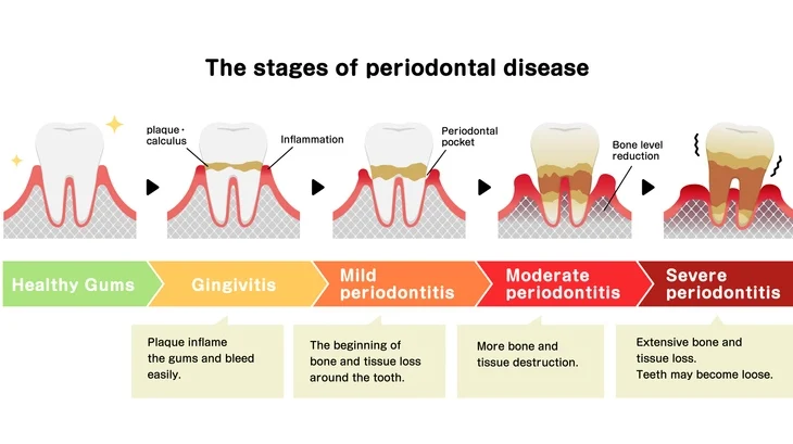 Classification of Periodontal Diseases