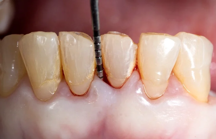 Diagnosis and Monitoring of Periodontal Diseases