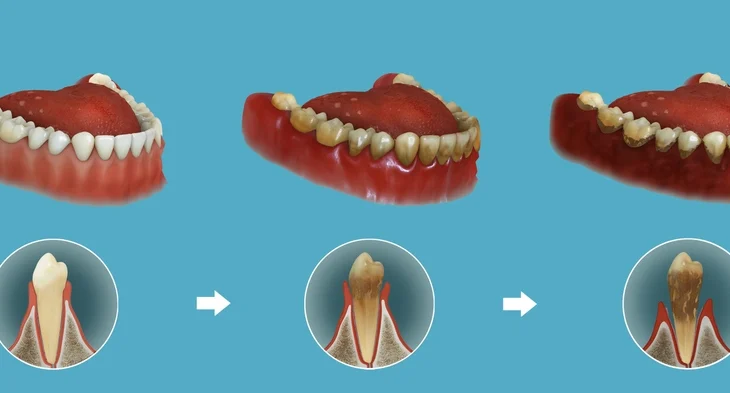 Gingivitis and Periodontitis