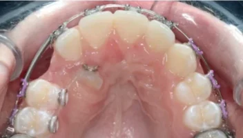 Palatally Displaced Maxillary Canines