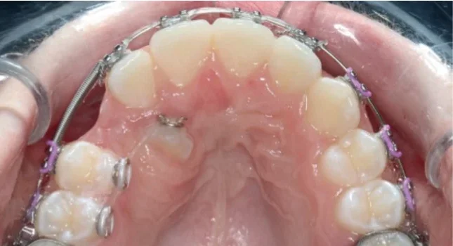 Palatally Displaced Maxillary Canines