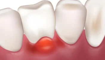 Periodontal Abscess