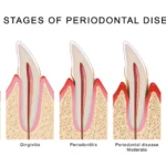 Periodontal Disease