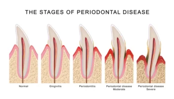 Periodontal Disease