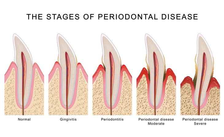 Periodontal Disease