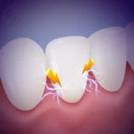 Pulpal sequelae following dental trauma