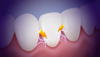 Pulpal sequelae following dental trauma