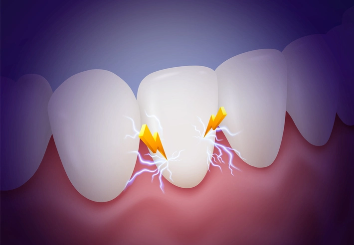 Pulpal sequelae following dental trauma