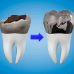 Stainless Steel Crowns