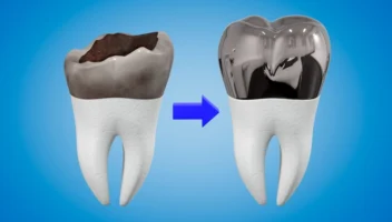 Stainless Steel Crowns