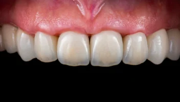 Anterior Crowns